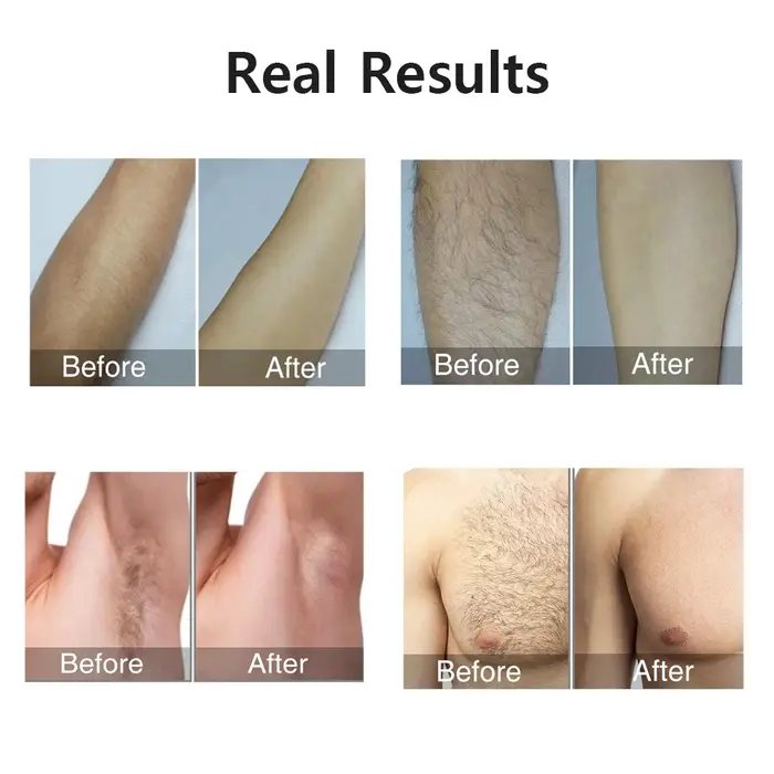 HOMEFISH Laser épilateur IPL épilation pour femmes corps Bikini visage 990000 flashs Permanent indolore IPL