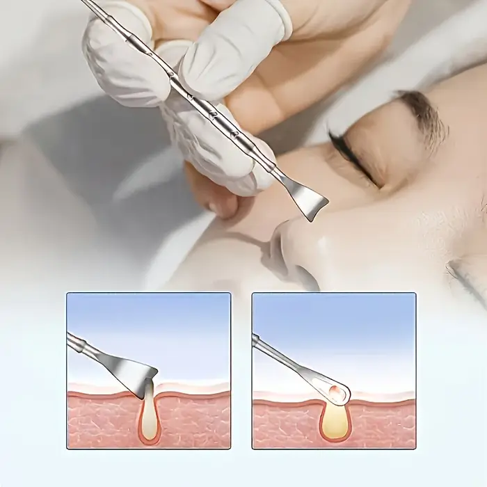 Kit d'extraction de comédons 2 pièces + extracteur de points noirs à double tête