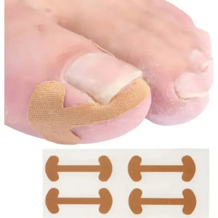 Patch adhésif pour ongles incarnés (5/10/20/30 feuilles) – Autocollant correcteur d'ongles