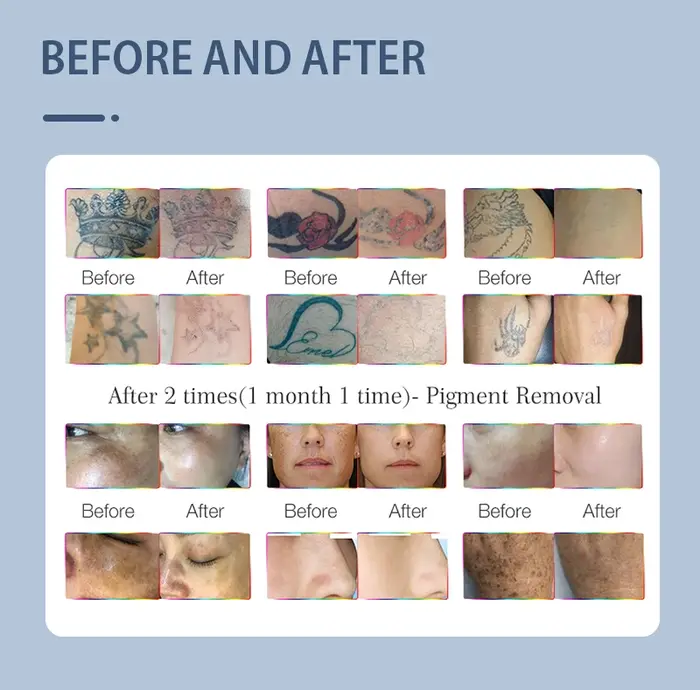 Nouvelle Machine Laser Picoseconde Portable Haut de Gamme 2025 pour l'Élimination des Tatouages