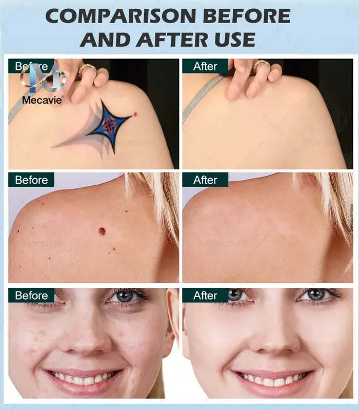 Laser Diode et Laser Picoseconde 2 en 1, Machine d'épilation au laser Diode 808 et d'élimination des tatouages avec 4 longueurs d'onde 755 808 940 1064nm