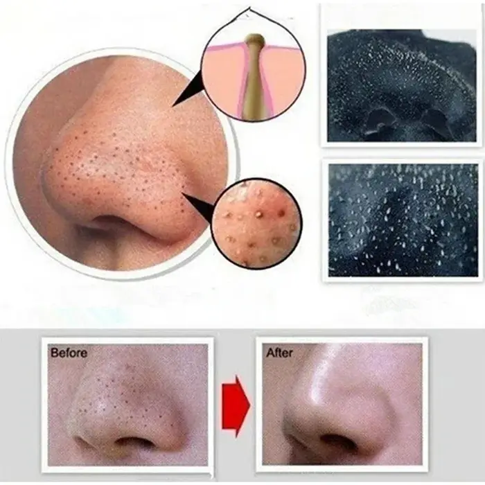 Masque dissolvant de points noirs pour le visage