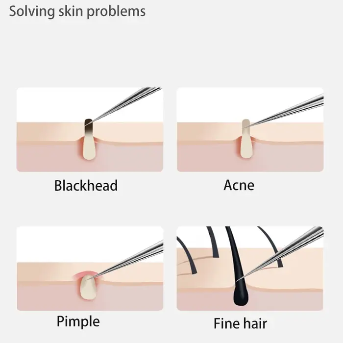 Pince à points noirs, outils pour enlever les points noirs