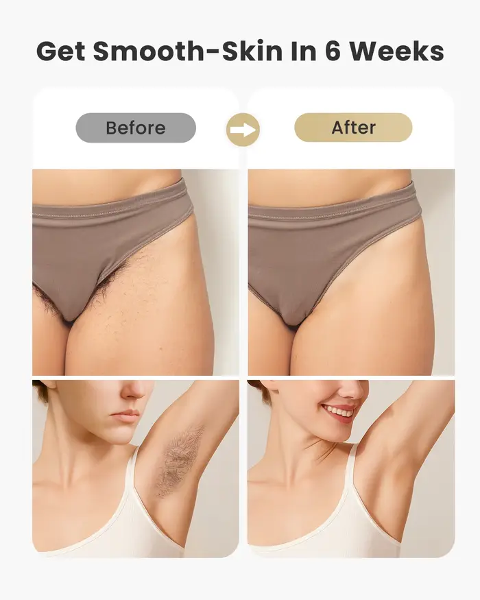 Épilation au laser IPL 0