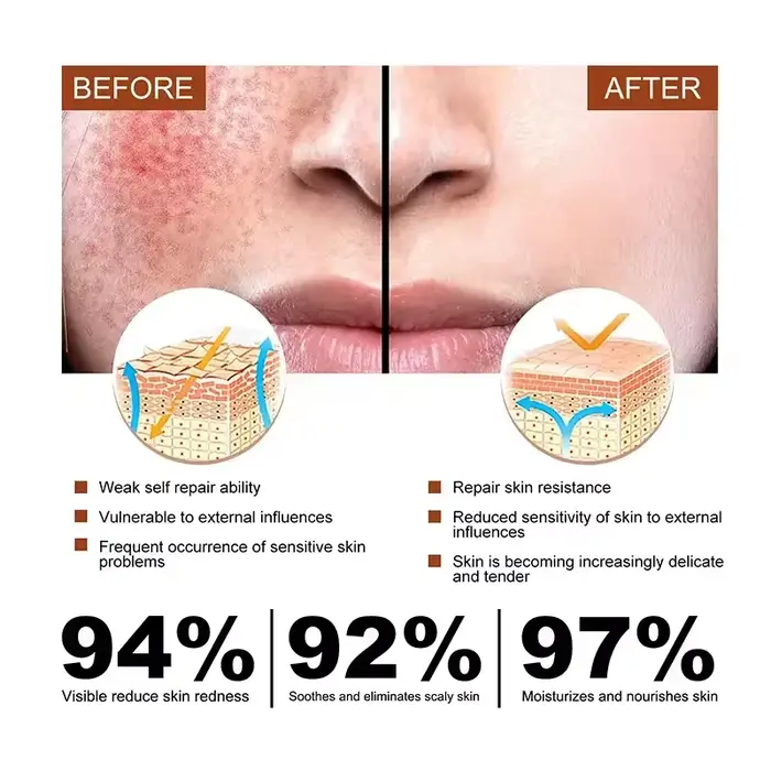 Crème réparatrice pour les rougeurs du visage