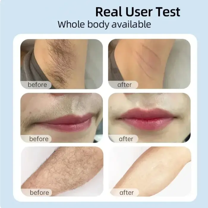 Dispositif d'épilation au Laser IPL épilateur