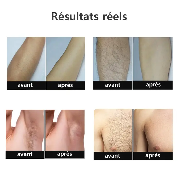 Depilador a laser ipl, remoção de pelos para mulheres